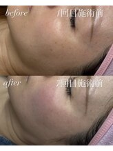 ベイビースキン(Baby skin)/シミケア～10分当て放題～