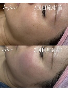 ベイビースキン(Baby skin)/シミケア~10分当て放題~