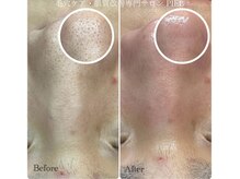 ピエル 北千住店(PIEL)/毛穴のお悩み
