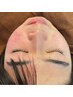 OPEN特価【毛穴/ニキビ/シミ】 肌質改善プログラム(無針水光注入)通常12000円