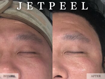 レヴェリー 心斎橋店(REVERIE)/‐ ジェット美容液導入 ‐