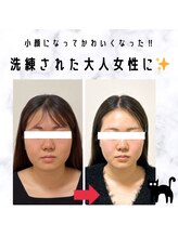 顔凛(カオリン)/20代女性の小顔矯正