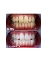 ホワイトニングサロン 名古屋駅店/【ホワイトニング施術例】