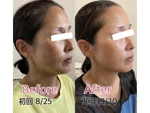 ラブ美長寿 沖縄本店(Lab)/光フェイシャル＆エンダモリフト