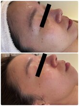 エイシスグロウ(asis glow.)/効果写真