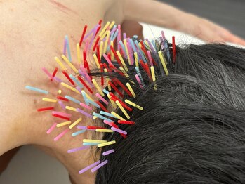 とだ鍼灸院の写真/浅層~深層にある痛みを感じる箇所“トリガーポイント”に鍼施術! 副交感神経亢進/全身血流up☆可動域改善◎