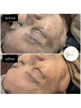 グレイス(Grace)/光フェイシャル