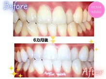 エクシアホワイトニング 天神店/ビフォーアフター　6カ月後