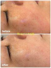 ミレボ(Me.rebo)/復元パック　before→after