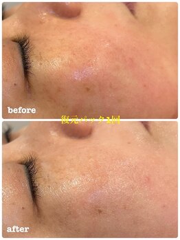 ミレボ(Me.rebo)/復元パック　before→after