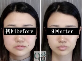 キュープ 鹿児島伊集院店(Qpu)/オイルコース9回での変化