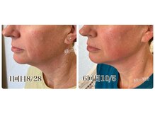 ラブ美長寿 沖縄本店(Lab)/ビフォーアフターエンダモリフト