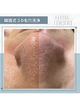 スキンラボアメリ(skin lab. ameri)/毛穴洗浄ーー症例はこちらー→