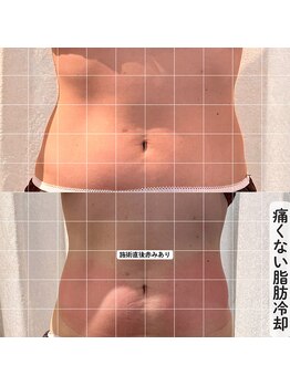 ココロ(COCORO)/脂肪冷却