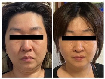 リンダ(Rinda)/レッドショット★すっきり小顔♪