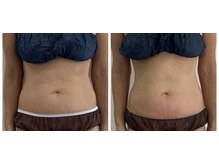 ケーサロン 志木店(K salon)/脂肪冷却モニター2カップ