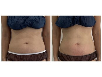 ケーサロン 志木店(K salon)/脂肪冷却モニター2カップ