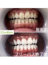 ルブラン 奈良店(Le Blanc)/削らずに歯を白く！
