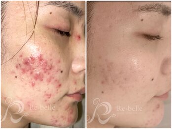 まいれ整骨院 大津市堅田院 マイレ 堅田店(MAILE)/あらゆるニキビケア