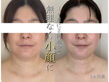 ココスターリー(Coco starry)/1ヶ月に2回来店、3ヶ月後の様子