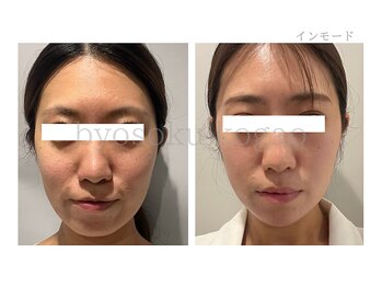 メディカルエステ 新宿南口店/*インモードリフト症例写真*