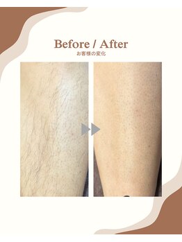 ラヴィ コロレ(La vie colore)/メンズあし脱毛