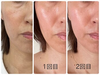 ラ ルミエール(La Lumiere)/ソフトダーマ2回の変化