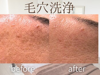 ラグレ(LUXRE)/ ハイドロ毛穴洗浄