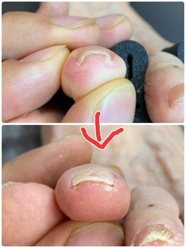 名古屋駅前巻き爪センター/巻き爪