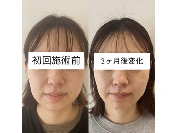 リアプア(Li'a)の写真/『小顔になりたい方』　たるみから整える小顔ケア│変化実感で叶えるリフトアップ小顔　小顔矯正/たるみ