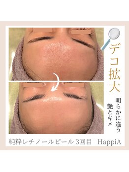 ハピア(HappiA)/純粋レチノールピール