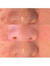 シャイン(Shine)/韓国式3D毛穴洗浄とプラズマ