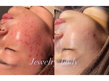 ジュエリーボディー(Jewelry body)/ハーブピーリング