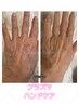 【年齢が出やすい手元に】シミ/シワ改善！プラズマハンドケアコース60分