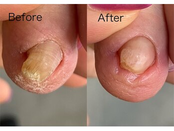 ロンディネ(Rondine)/巻き爪ケア&Nail trim