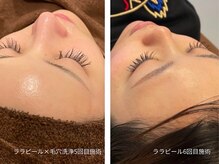 ライフサロン 天神(Life Salon)/ララピール×毛穴洗浄