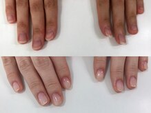 エスネイル(S-nail)/深爪矯正/自爪育成