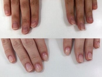 エスネイル(S-nail)/深爪矯正/自爪育成