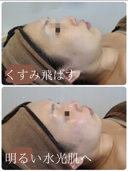 サロンド シェリー(Salon de Cherie)/剥けないハーブピーリング