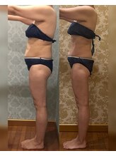 ヴィクトワール シュエット/【痩身】50代のお客様の変化