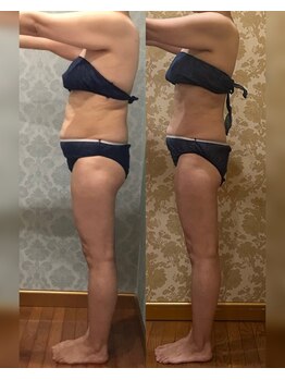 ヴィクトワール シュエット/【痩身】50代のお客様の変化
