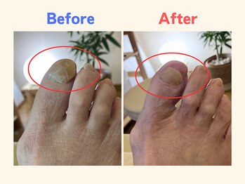 ピース/分厚くなった爪が辛い60代女性