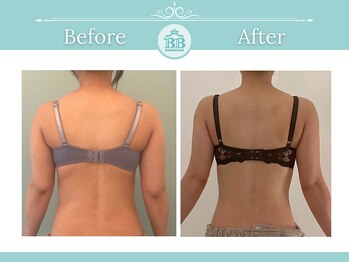 美人バスト つくば店/【バストアップ/育乳 症例】