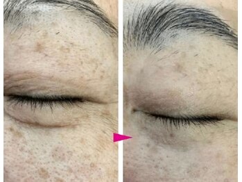 プリオール 高崎花水木店(Prior)/ヒト幹細胞×エステダーマ