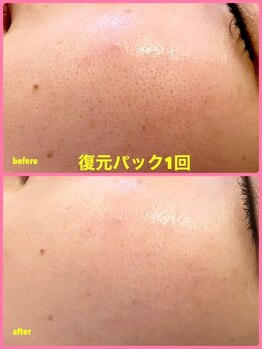 ミレボ(Me.rebo)/復元パック　before→after