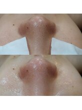 ボーソリューション(Beau-Solution)/【20代 詰まり・黒ずみ毛穴1回】