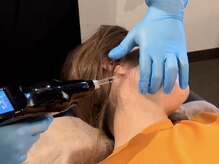 針なし×痛みなしで小顔リフトアップ！