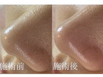 ドラーダ(DORADA)/【毛穴洗浄】毛穴詰まり改善