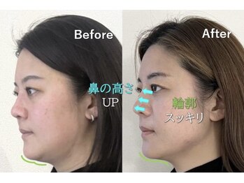 ラプリ 横浜店(Raplit)/隆鼻+輪郭矯正40分10回