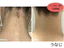 クオッカ(Quokka)の雰囲気(【うなじ脱毛】ビフォーアフター)